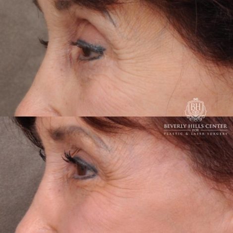 Beverly Hills Center Female Patient Before and After AuraLyft and Eye & Brow Lift