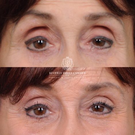 Beverly Hills Center Female Patient Before and After AuraLyft and Eye & Brow Lift
