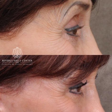 Beverly Hills Center Female Patient Before and After AuraLyft and Eye & Brow Lift