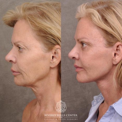 Beverly Hills Center Female Patient Before and After AuraLyft, Cupid Lift® and Eye & Brow Lift