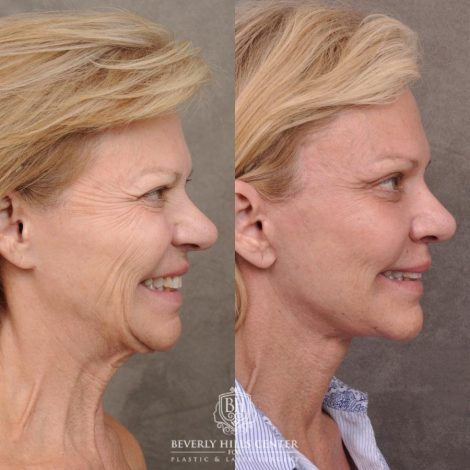 Beverly Hills Center Female Patient Before and After AuraLyft, Cupid Lift® and Eye & Brow Lift