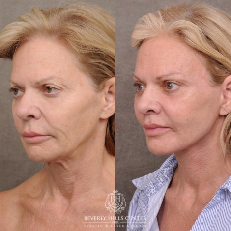 Beverly Hills Center Female Patient Before and After AuraLyft, Cupid Lift® and Eye & Brow Lift