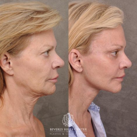 Beverly Hills Center Female Patient Before and After AuraLyft, Cupid Lift® and Eye & Brow Lift