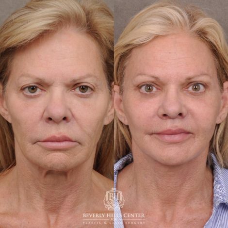 Beverly Hills Center Female Patient Before and After AuraLyft, Cupid Lift® and Eye & Brow Lift