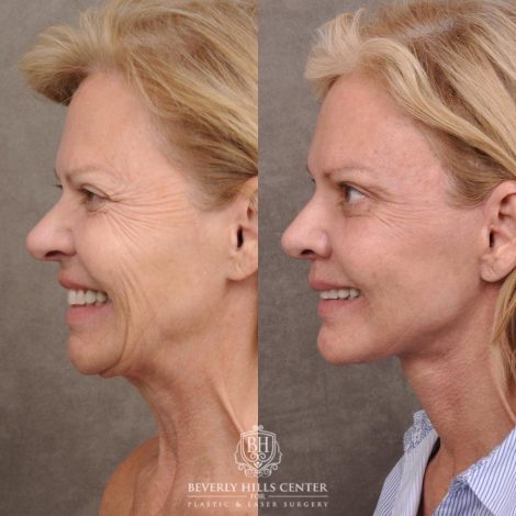 Beverly Hills Center Female Patient Before and After AuraLyft, Cupid Lift® and Eye & Brow Lift