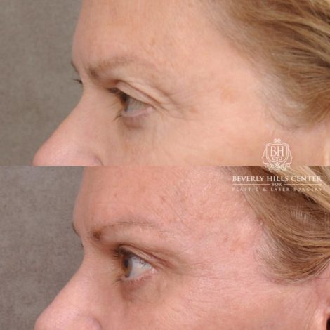 Beverly Hills Center Female Patient Before and After AuraLyft, Cupid Lift® and Eye & Brow Lift