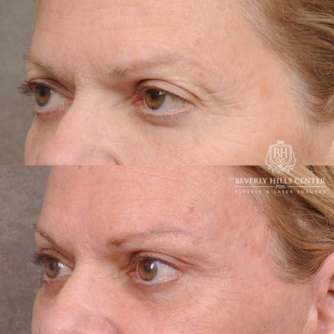 Beverly Hills Center Female Patient Before and After AuraLyft, Cupid Lift® and Eye & Brow Lift