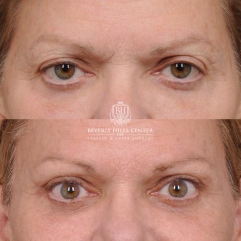 Beverly Hills Center Female Patient Before and After AuraLyft, Cupid Lift® and Eye & Brow Lift