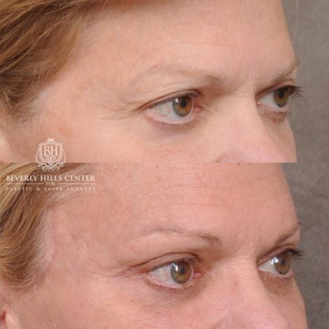 Beverly Hills Center Female Patient Before and After AuraLyft, Cupid Lift® and Eye & Brow Lift