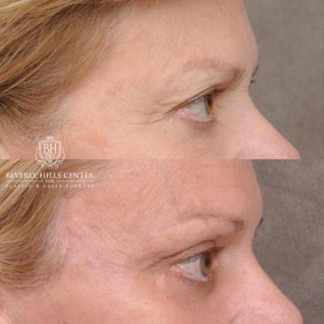 Beverly Hills Center Female Patient Before and After AuraLyft, Cupid Lift® and Eye & Brow Lift