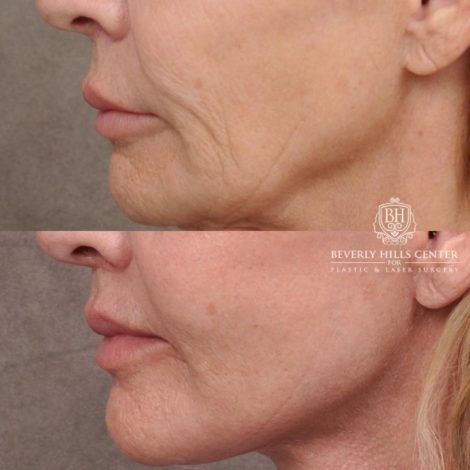 Beverly Hills Center Female Patient Before and After AuraLyft, Cupid Lift® and Eye & Brow Lift