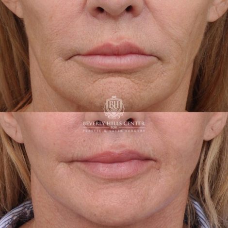 Beverly Hills Center Female Patient Before and After AuraLyft, Cupid Lift® and Eye & Brow Lift