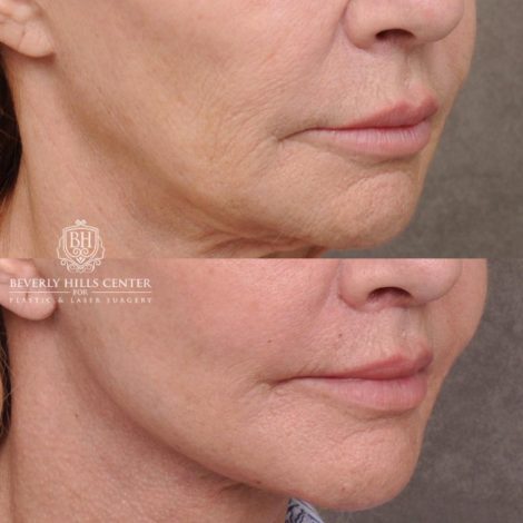 Beverly Hills Center Female Patient Before and After AuraLyft, Cupid Lift® and Eye & Brow Lift
