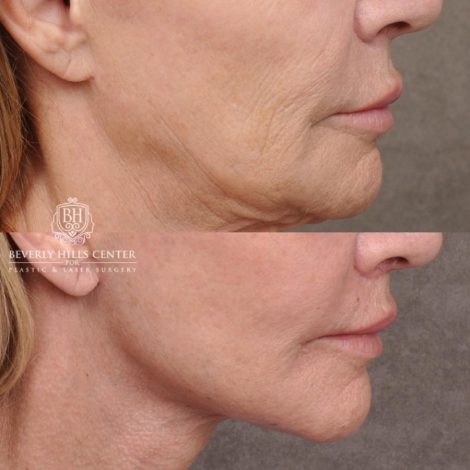 Beverly Hills Center Female Patient Before and After AuraLyft, Cupid Lift® and Eye & Brow Lift