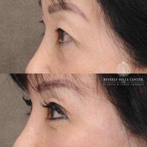 Beverly Hills Center Female Patient Before and After AuraLyft and Eye & Brow Lift