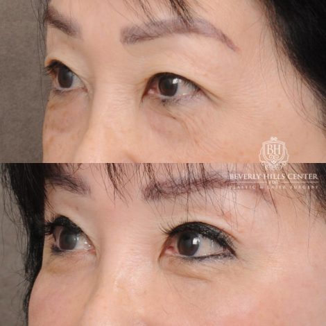 Beverly Hills Center Female Patient Before and After AuraLyft and Eye & Brow Lift