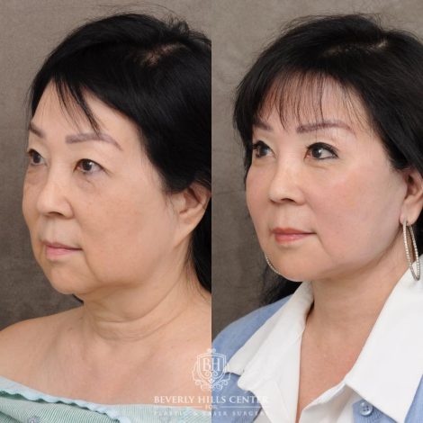 Beverly Hills Center Female Patient Before and After AuraLyft and Eye & Brow Lift