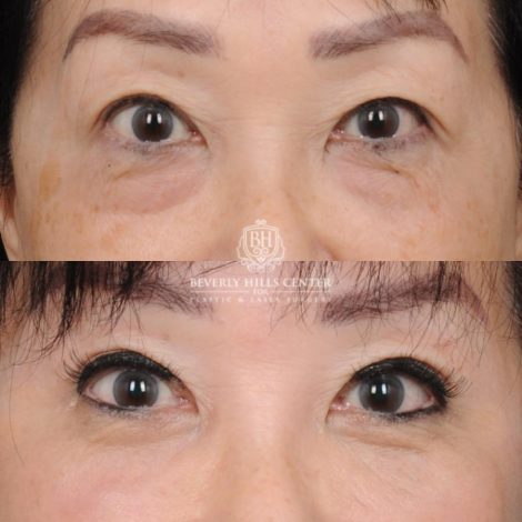Beverly Hills Center Female Patient Before and After AuraLyft and Eye & Brow Lift