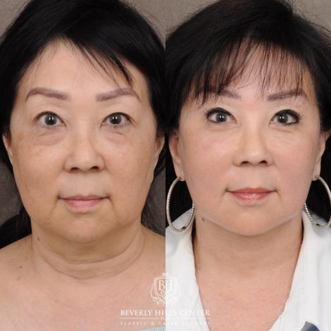 Beverly Hills Center Female Patient Before and After AuraLyft and Eye & Brow Lift