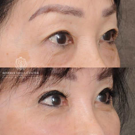 Beverly Hills Center Female Patient Before and After AuraLyft and Eye & Brow Lift