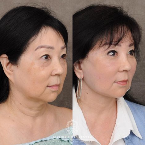 Beverly Hills Center Female Patient Before and After AuraLyft and Eye & Brow Lift