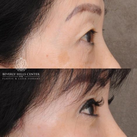 Beverly Hills Center Female Patient Before and After AuraLyft and Eye & Brow Lift