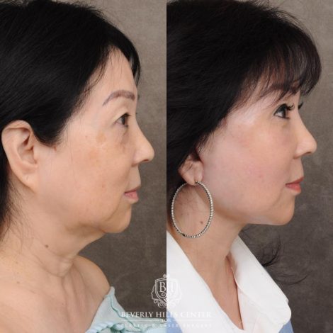 Beverly Hills Center Female Patient Before and After AuraLyft and Eye & Brow Lift