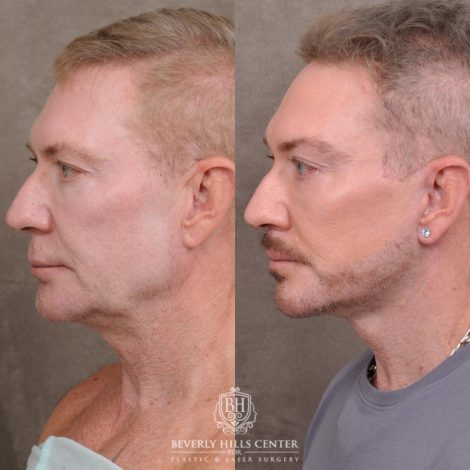 Beverly Hills Center Male Patient Before and After AuraLyft and Eye & Brow Lift