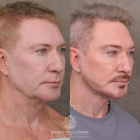 Beverly Hills Center Male Patient Before and After AuraLyft and Eye & Brow Lift