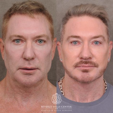 Beverly Hills Center Male Patient Before and After AuraLyft and Eye & Brow Lift