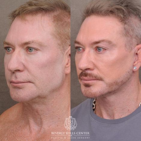 Beverly Hills Center Male Patient Before and After AuraLyft and Eye & Brow Lift
