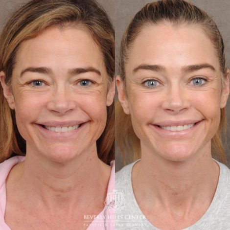 Beverly Hills Center Female Patient – Before and After AuraLyft, Eye & Brow Lift, and Cupid Lift®