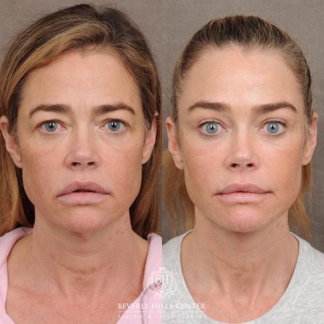 Beverly Hills Center Female Patient – Before and After AuraLyft, Eye & Brow Lift, and Cupid Lift®