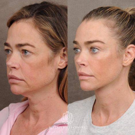 Beverly Hills Center Female Patient – Before and After AuraLyft, Eye & Brow Lift, and Cupid Lift®