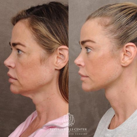 Beverly Hills Center Female Patient – Before and After AuraLyft, Eye & Brow Lift, and Cupid Lift®