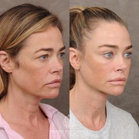 Beverly Hills Center Female Patient – Before and After AuraLyft, Eye & Brow Lift, and Cupid Lift®