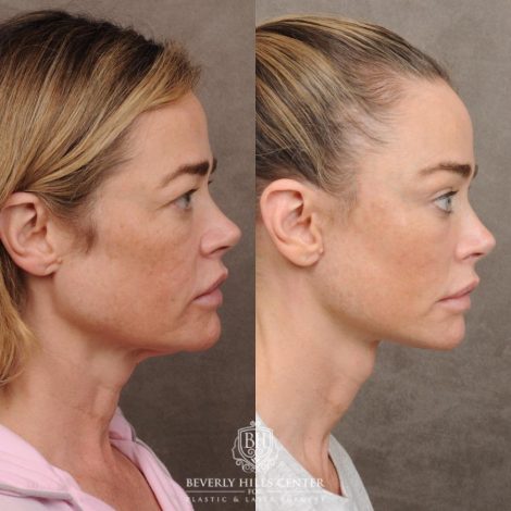 Beverly Hills Center Female Patient – Before and After AuraLyft, Eye & Brow Lift, and Cupid Lift®