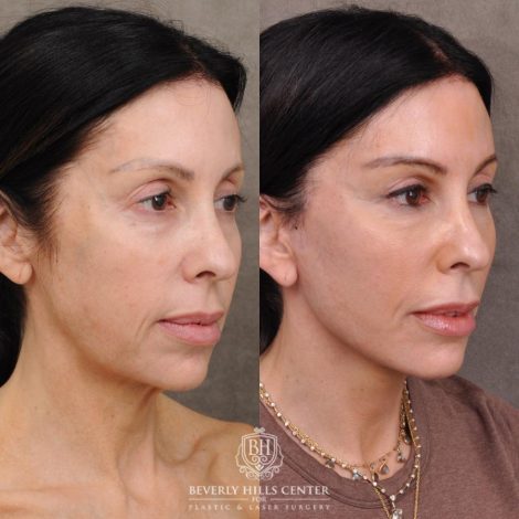 Beverly Hills Center Female Patient Before and After Auralyft, Eyes & Brows, Face & Neck