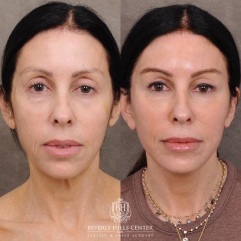 Beverly Hills Center Female Patient Before and After Auralyft, Eyes & Brows, Face & Neck