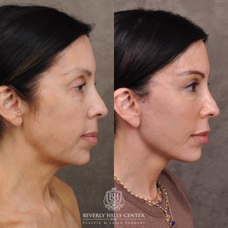 Beverly Hills Center Female Patient Before and After Auralyft, Eyes & Brows, Face & Neck