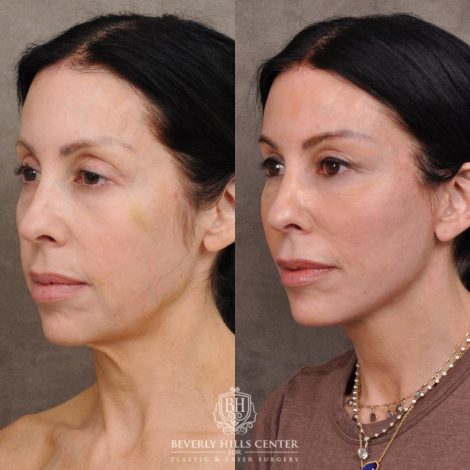 Beverly Hills Center Female Patient Before and After Auralyft, Eyes & Brows, Face & Neck