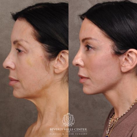 Beverly Hills Center Female Patient Before and After Auralyft, Eyes & Brows, Face & Neck