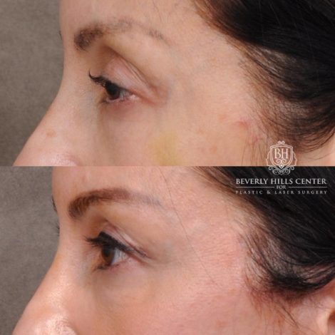 Beverly Hills Center Female Patient Before and After Auralyft, Eyes & Brows, Face & Neck