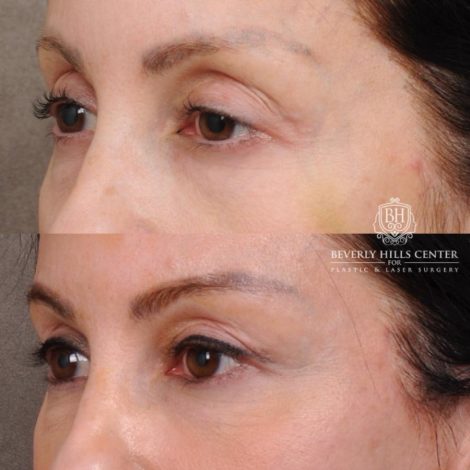 Beverly Hills Center Female Patient Before and After Auralyft, Eyes & Brows, Face & Neck