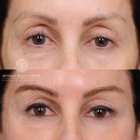 Beverly Hills Center Female Patient Before and After Auralyft, Eyes & Brows, Face & Neck