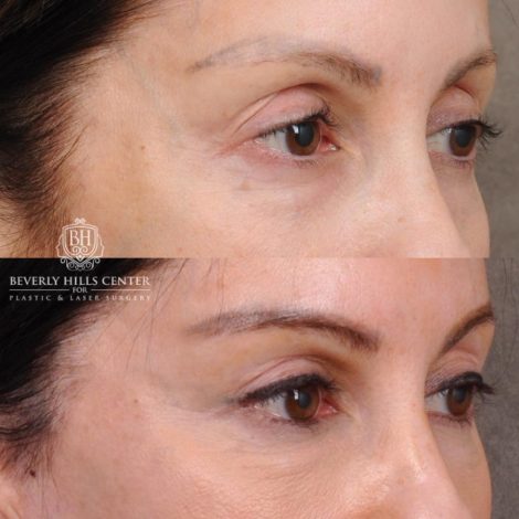 Beverly Hills Center Female Patient Before and After Auralyft, Eyes & Brows, Face & Neck