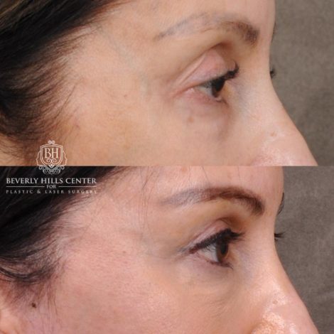 Beverly Hills Center Female Patient Before and After Auralyft, Eyes & Brows, Face & Neck