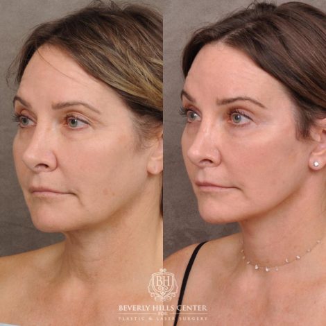 Beverly Hills Center Female Patient Before and After Auralyft, Eyes & Brows, Face & Neck