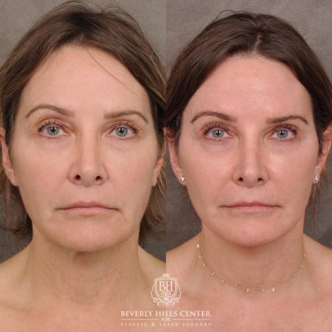 Beverly Hills Center Female Patient Before and After Auralyft, Eyes & Brows, Face & Neck