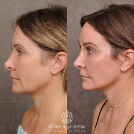 Beverly Hills Center Female Patient Before and After Auralyft, Eyes & Brows, Face & Neck
